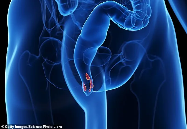 Toilet Terror to Relief: The Surprising Reality of Haemorrhoids and a Growing Health Crisis