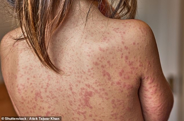 UK Measles Crisis: Calls for School Exclusions as Vaccination Rates Drop