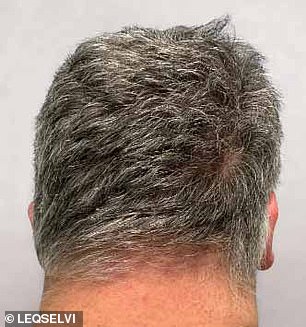 MHRA Approves Leqselvi (Deuruxolitinib) as Breakthrough Therapy for Severe Alopecia Areata