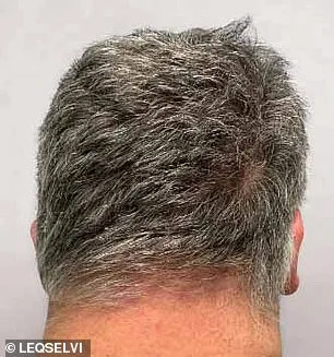 MHRA Approves Leqselvi (Deuruxolitinib) as Breakthrough Therapy for Severe Alopecia Areata