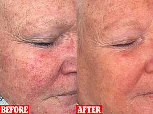 Beyond Stigma: The Profound Physical and Mental Toll of Neglected Skin Diseases