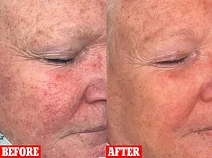 Beyond Stigma: The Profound Physical and Mental Toll of Neglected Skin Diseases