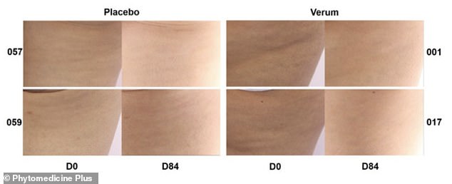 Cellulite's New Foe: Daily Oral Supplement Derived from French Maritime Pine Bark