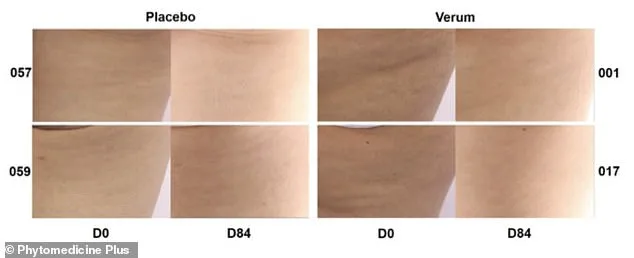 Cellulite's New Foe: Daily Oral Supplement Derived from French Maritime Pine Bark