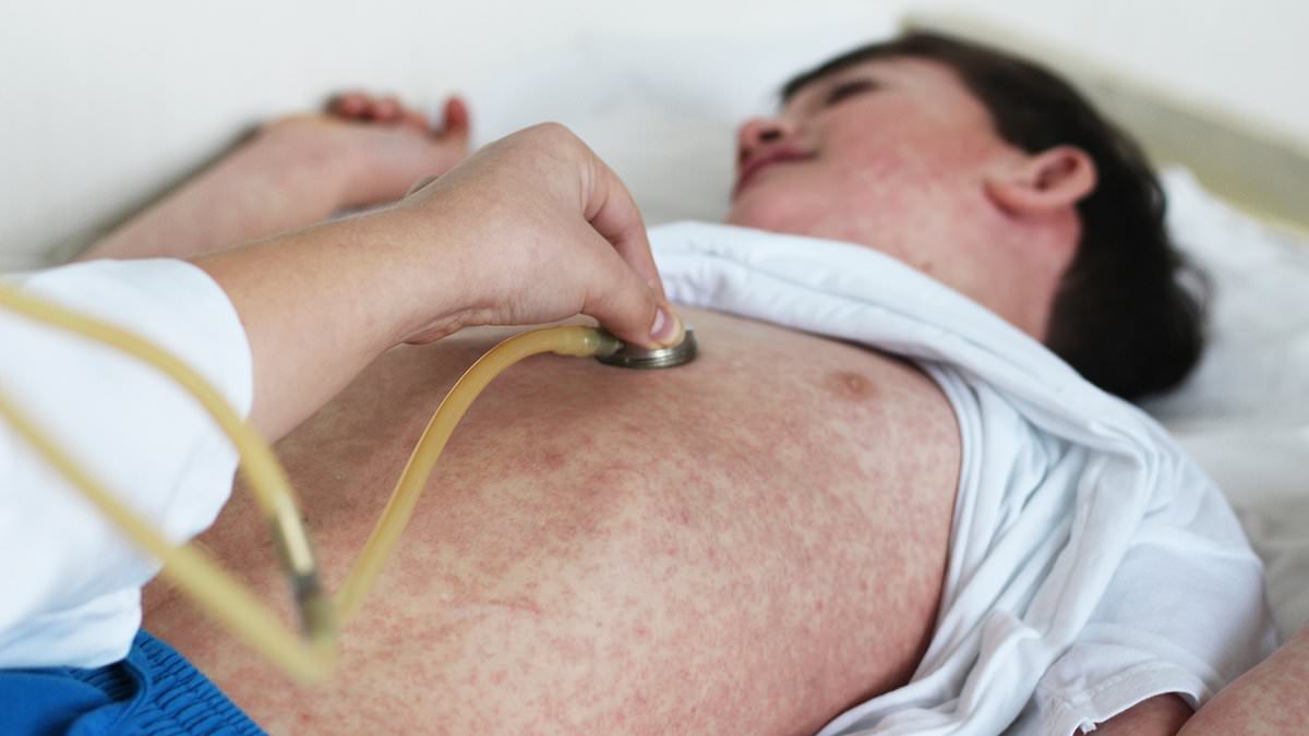 Measles Outbreak Spreads Across 11 States as Cases Reach 1,575 in 2023