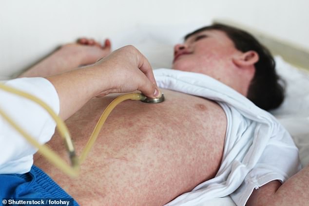 Measles Outbreak Spreads Across 11 States as Cases Reach 1,575 in 2023