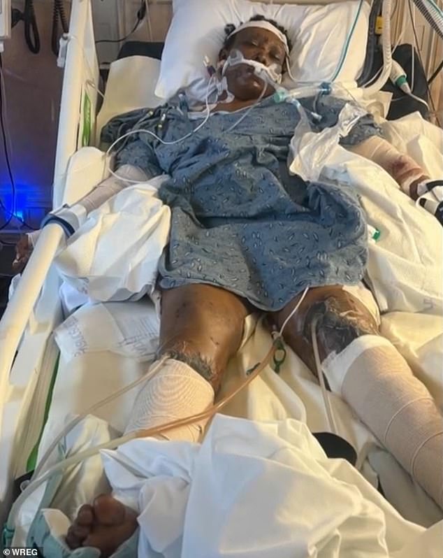 Mississippi Woman's Life Shattered by Horrific Dog Attack, Leading to Amputation and Long Road to Recovery