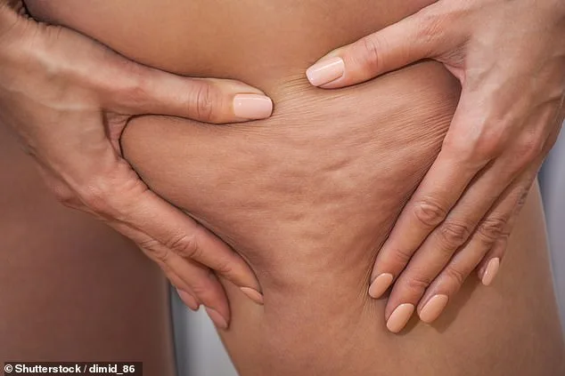 Lipoedema: The Hidden Condition Reshaping Body Image and Medical Care