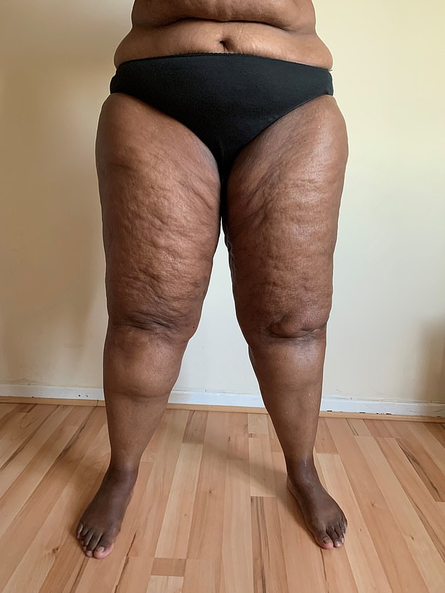 Lipoedema: The Hidden Condition Reshaping Body Image and Medical Care