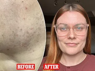 Aida Azizii's Ten-Year Battle with PCOS: Navigating Hormonal Chaos and Weight Struggles