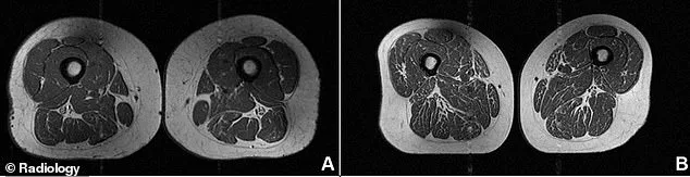 Marbling Fat in Muscles: The Dark Side of Ultra-Processed Diets