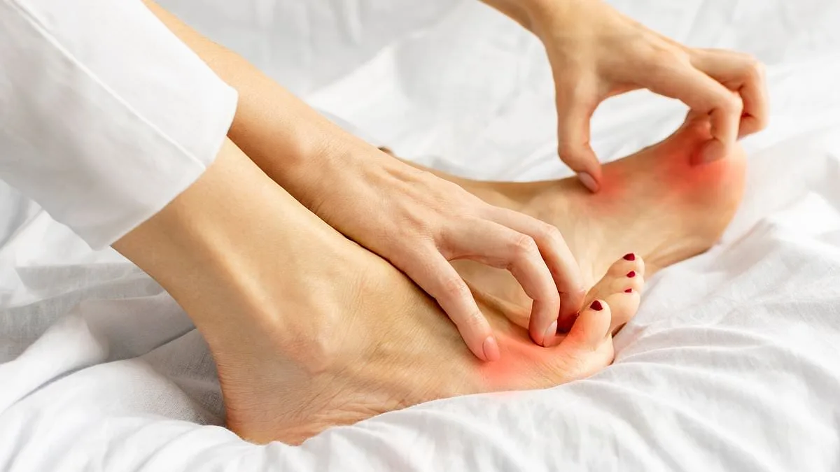 UK Sees Surge in Resistant Athlete's Foot Cases Affecting Millions