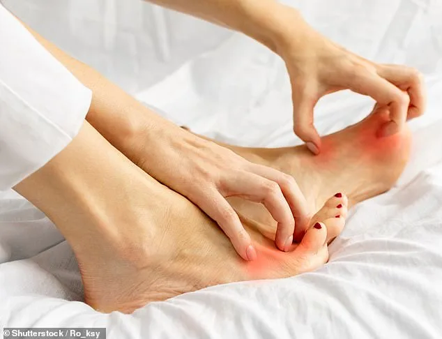 UK Sees Surge in Resistant Athlete's Foot Cases Affecting Millions