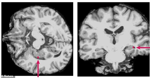Brain stays active and processes language even under general anesthesia.