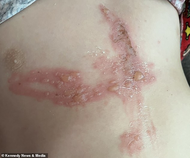 Boy Suffers Severe Burns After Mistaking Giant Hogweed for Toy