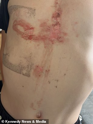 Boy Suffers Severe Burns After Mistaking Giant Hogweed for Toy