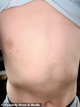 Boy Suffers Severe Burns After Mistaking Giant Hogweed for Toy
