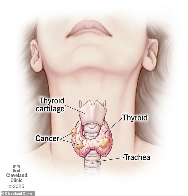 Two-Year Hiccups Mask Deadly Cancer Rising in Young People
