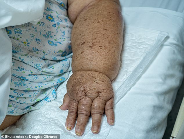 New Trial Shows Many Breast Cancer Patients Can Avoid Debilitating Arm Swelling