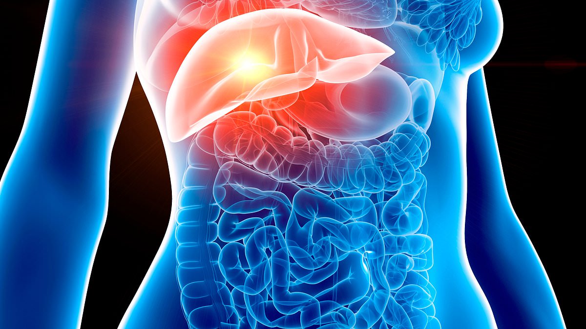 Fatty Livers Linked to Aggressive Bowel Cancer Surge in UK.