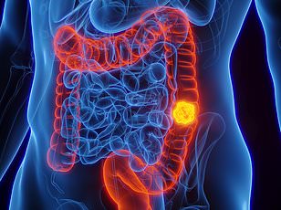 Fatty Livers Linked to Aggressive Bowel Cancer Surge in UK.