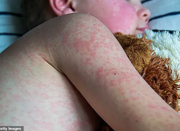 Houston Reports New Measles Case; Health Officials Urgent Advisory for Limited Public Access to Critical Vaccine Information