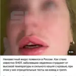 Mysterious Illness with Bloody Cough Spreads in Russia