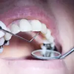 Record Numbers Seeking Removal of Amalgam Fillings Post EU Ban
