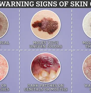 Study Reveals Tattooed Individuals Face Up to 62% Higher Risk of Skin Cancer
