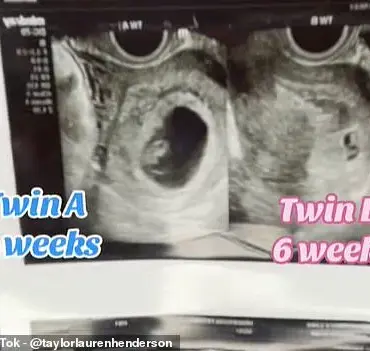 Texas Woman Makes Medical History with Rare Superfetation Pregnancy