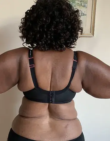 Woman's Decade-Long Struggle With Lipedema Reveals Truth Behind 'Fat Legs'