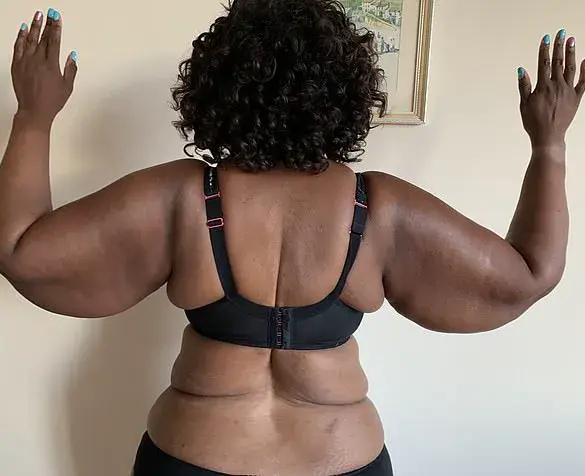 Woman's Decade-Long Struggle With Lipedema Reveals Truth Behind 'Fat Legs'