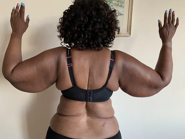 Woman's Decade-Long Struggle With Lipedema Reveals Truth Behind 'Fat Legs'