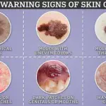 Dermatologist Warns: Pay Attention to How Moles Feel to Detect Melanoma