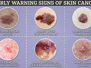 Dermatologist Warns: Pay Attention to How Moles Feel to Detect Melanoma