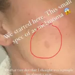 Dermatologist Warns: Pay Attention to How Moles Feel to Detect Melanoma