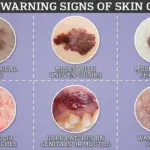 Rare and Rapid: Understanding Mucosal Melanoma's Deadly Progression