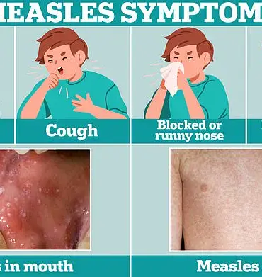 Unproven Vitamin A Treatment Linked to Hospitalizations in Texas Measles Outbreak