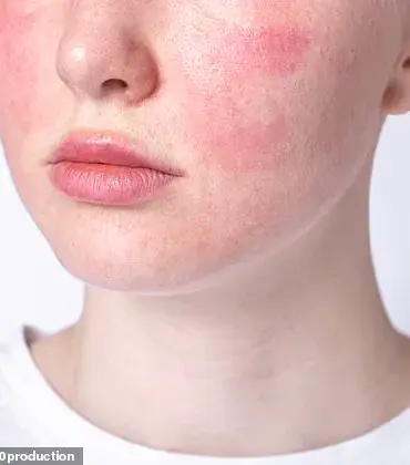 Urgent Advice for Rosacea Sufferers: Navigating Treatment Challenges with Dr Ellie Cannon