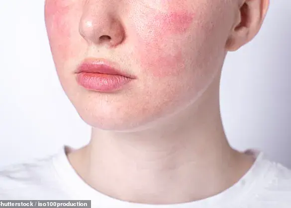 Urgent Advice for Rosacea Sufferers: Navigating Treatment Challenges with Dr Ellie Cannon