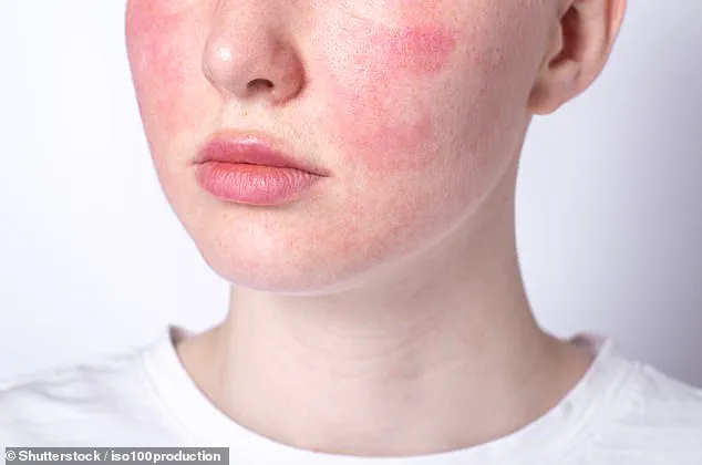 Urgent Advice for Rosacea Sufferers: Navigating Treatment Challenges with Dr Ellie Cannon