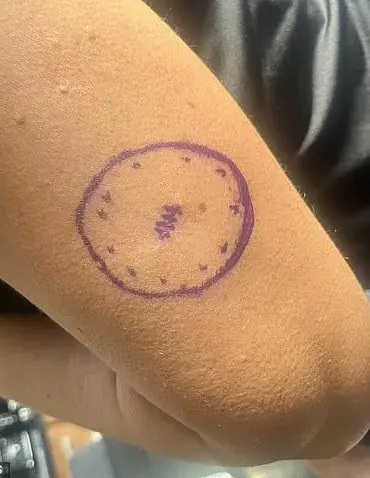 A Cancer Survivor's Warning: The Hidden Dangers of Sun Worship and the Importance of Early Detection
