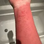 Woman's Severe Skin Condition Worsens After Steroid Cream Cessation