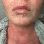 Woman's Severe Skin Condition Worsens After Steroid Cream Cessation