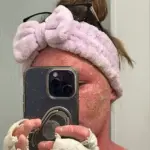 Woman's Severe Skin Condition Worsens After Steroid Cream Cessation