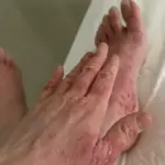 Woman's Severe Skin Condition Worsens After Steroid Cream Cessation