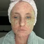 Woman's Severe Skin Condition Worsens After Steroid Cream Cessation