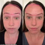 Xeomin Injections Lead to Controversy for California Mother