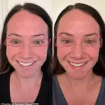 Xeomin Injections Lead to Controversy for California Mother
