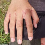 Expert Warns Holidaymakers of Scabies Risk from Leaving Luggage on Hotel Beds